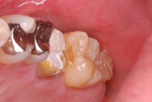 小樽歯科歯医者レジンを使用した白さを保ったままのむし歯の治療（保険内）