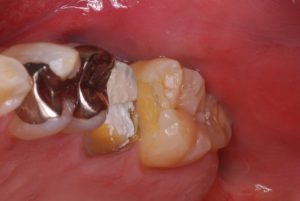 小樽歯科歯医者レジンを使用した白さを保ったままのむし歯の治療（保険内）